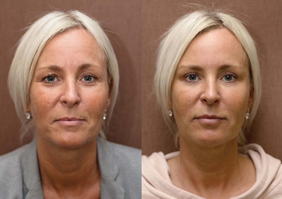 Плазменная подтяжка. Плазмотерапия плазмолифтинг косметология. Плазмолифтинг лица до и после.